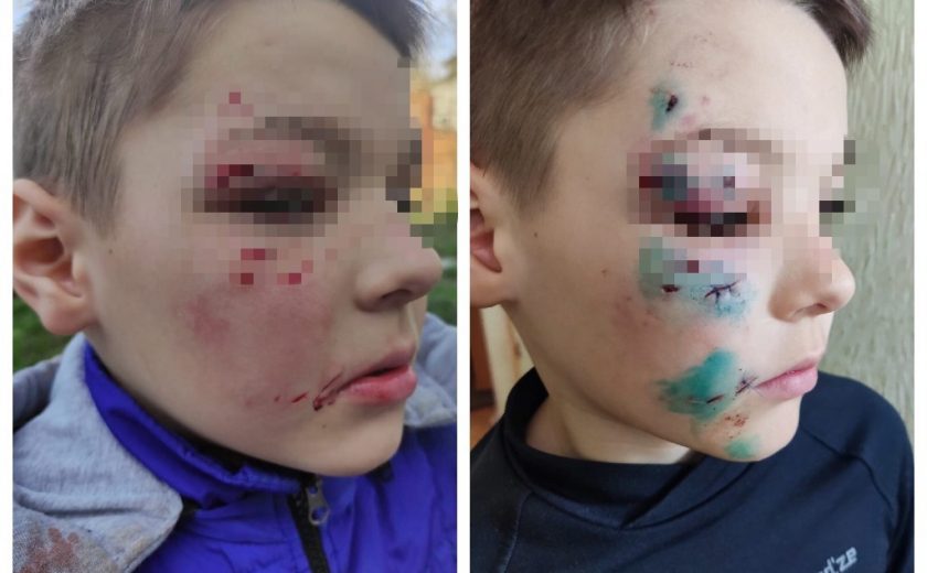 В Ясногорске собака укусила ребенка в лицо на детской площадке
